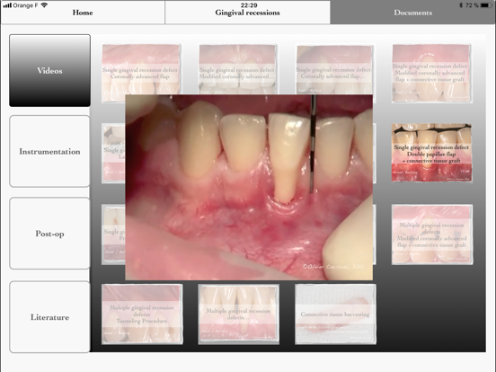 iMuco Gingival recessions iPad screenshot