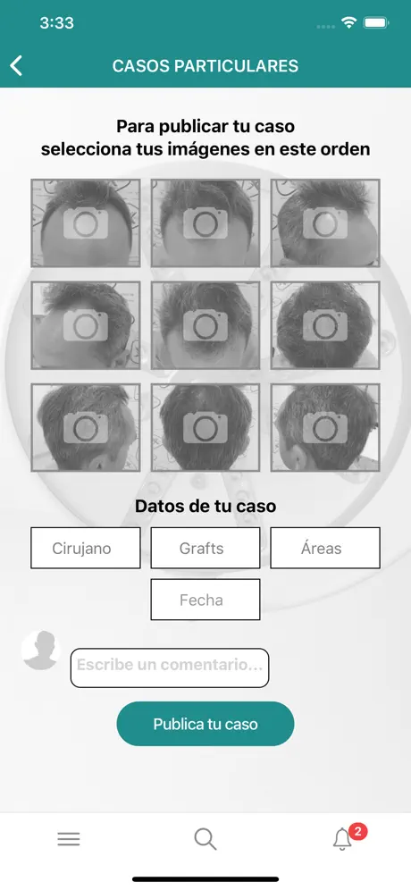 Injerto Capilar
