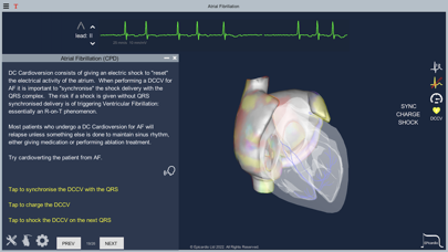 Atrial Fibrillation Screenshot