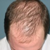 How To Treat Thinning Hair