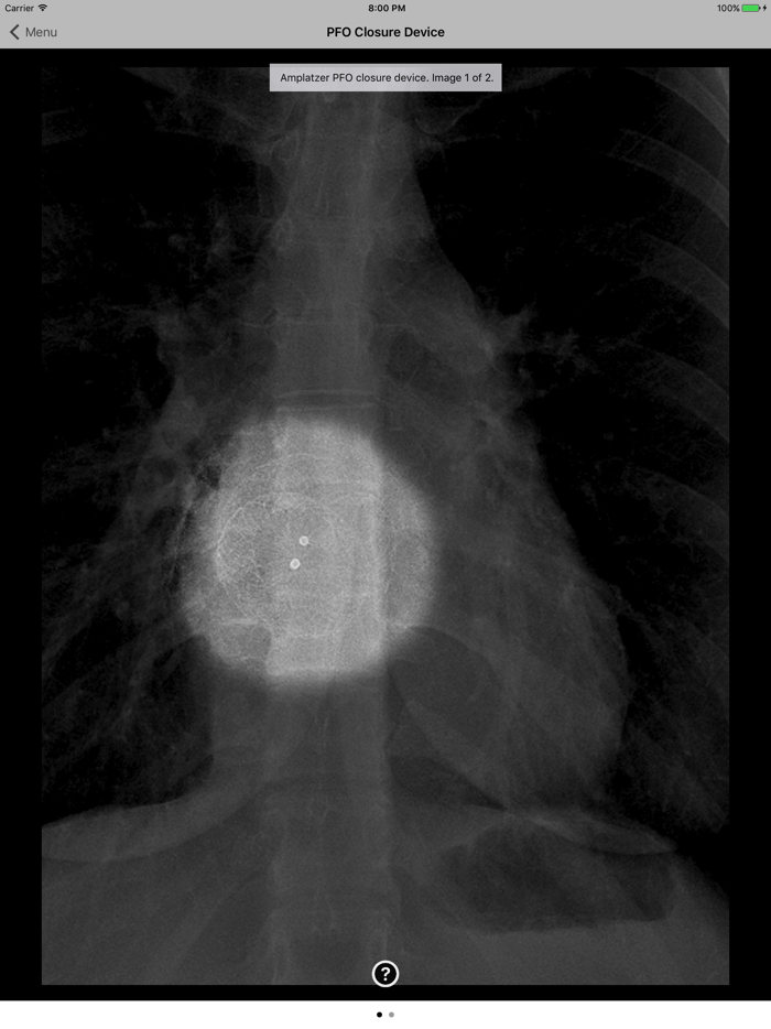 Medical Devices on Chest X-Ray