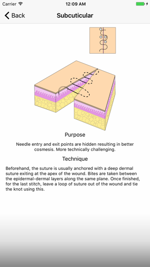 Suture Selector(圖5)-速報App
