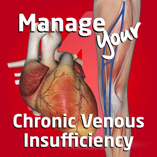 Manage your Chronic Venous Insufficiency 4 by Epat