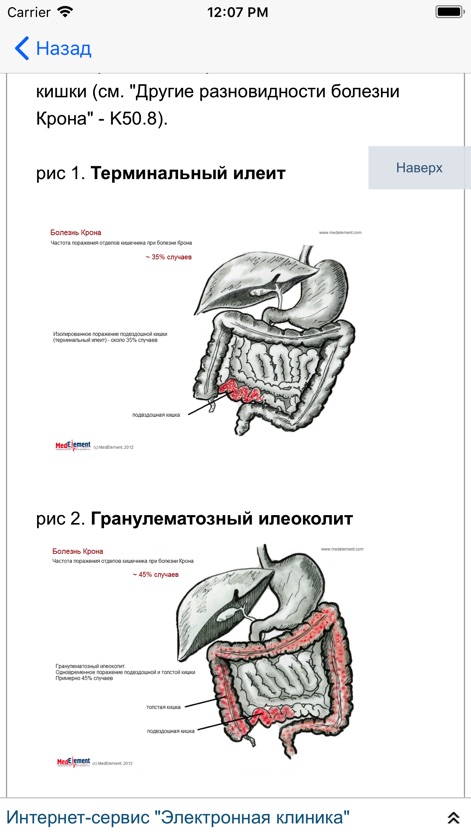 Заболевания: справочник врача - crohns-disease-anatomical-diagrams