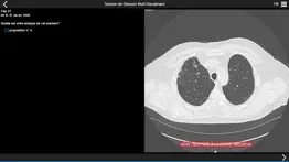 fibrose pulmonaire 2017 айфон картинки 1