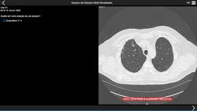 Fibrose pulmonaire 2017 screenshot