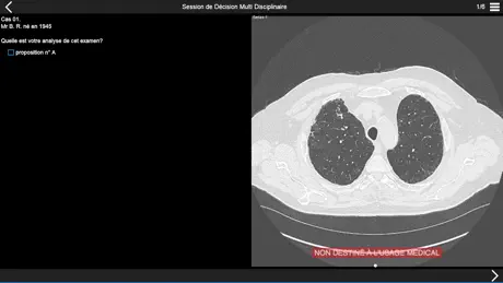 Fibrose pulmonaire 2017
