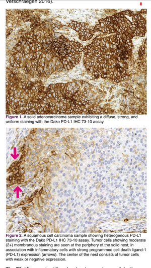 IASLC Atlas of PD-L1 Testing in Lung Cancer(圖4)-速報App