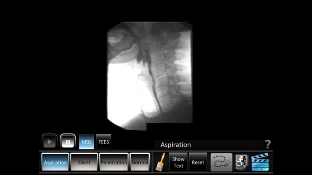 Aspiration Disorders(圖4)-速報App