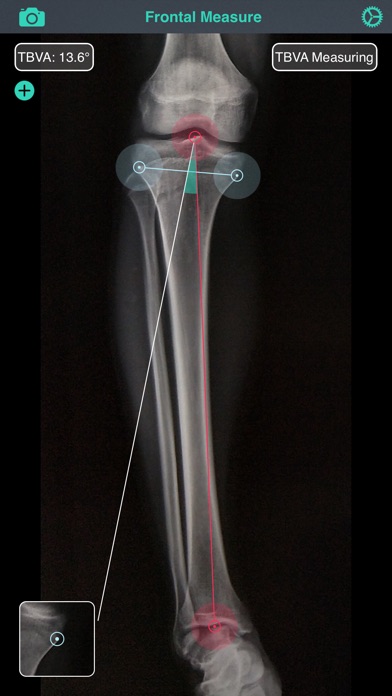 OsteoGauge - lower limb screenshot1