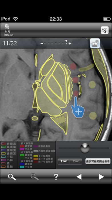 断面図ウォーカー脳MRI screenshot1