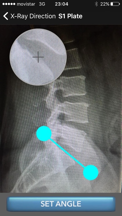 Sagittal Balance Advance LITE screenshot-3