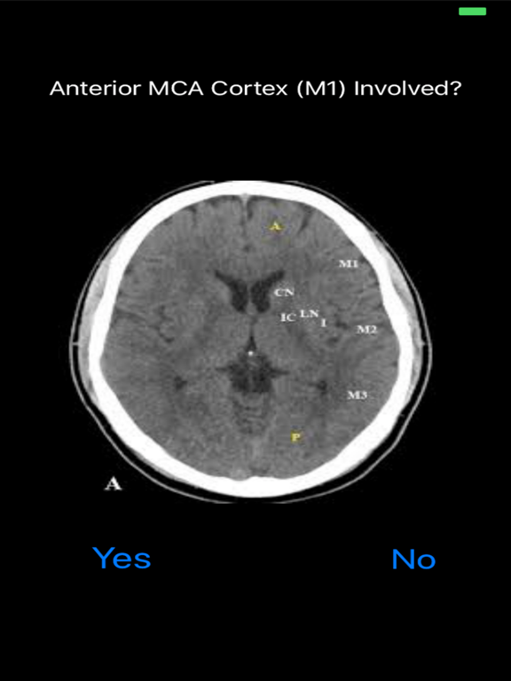Screenshot #5 pour ASPECTS Score Calculator