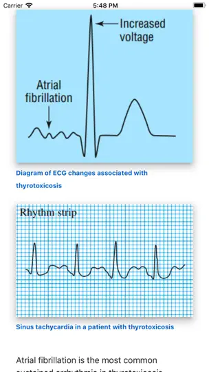 ECG Basics Lite: ECG Made Easy iPhone Screenshot 2