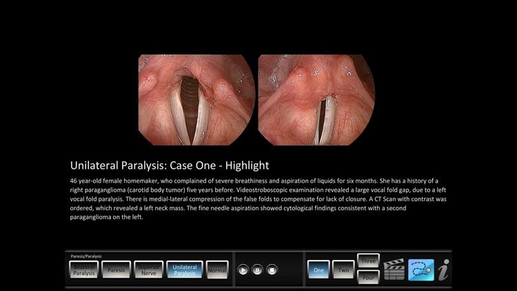 Paresis/Paralysis