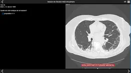 fibrose pulmonaire 2017 iphone screenshot 2