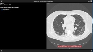 Fibrose pulmonaire 2017 screenshot #2 for iPhone