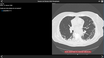 Fibrose pulmonaire 2017のおすすめ画像2