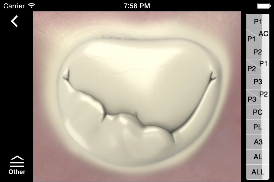 Mitral & Tricuspid Valves screenshot 4