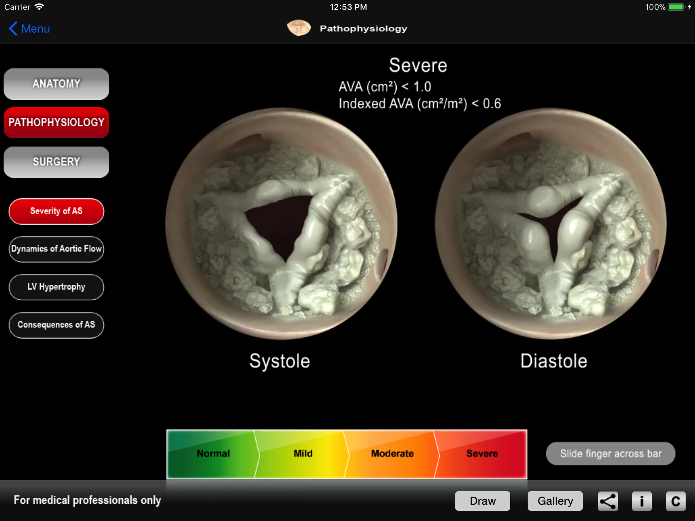 HEART MASTER Aortic Stenosis screenshot 4