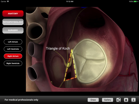 Mitral & Tricuspid Valves iPad screenshot 5 - Medical app