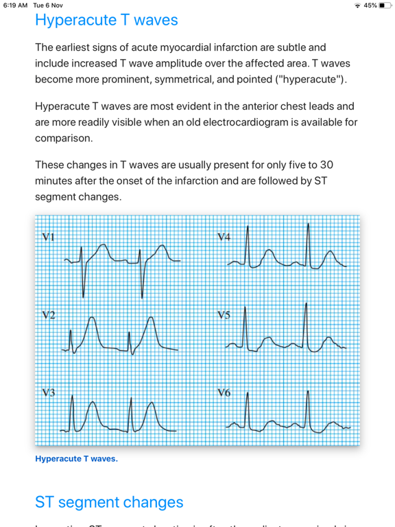 Screenshot #5 pour ECG Basics Lite: ECG Made Easy