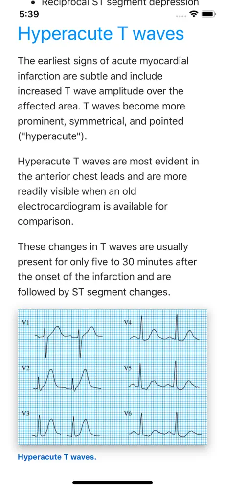 ECG Basics Lite: ECG Made Easy