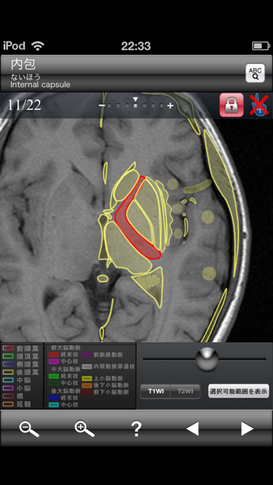 断面図ウォーカー脳MRI screenshot1