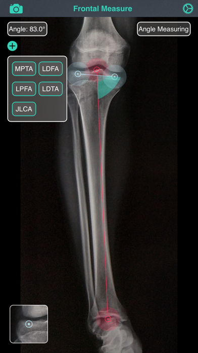 OsteoGauge - lower limb Screenshot