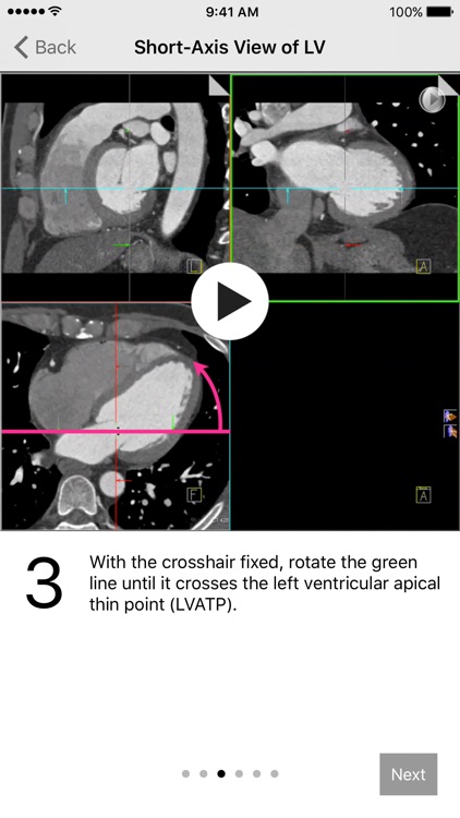 Cardiac Imaging Planes 1-2-3