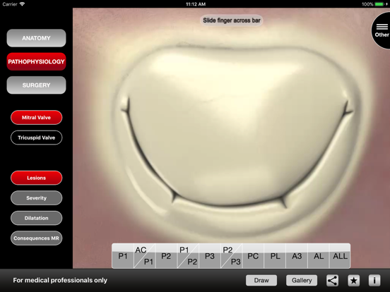 Mitral & Tricuspid Valves iPad screenshot 4 - Medical app