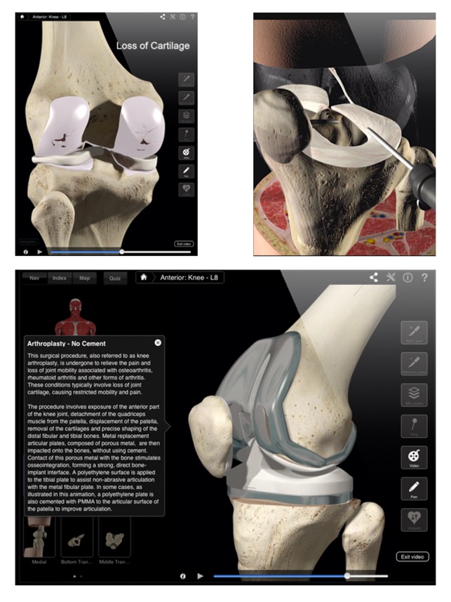Knee Pro III for iPad(圖2)-速報App