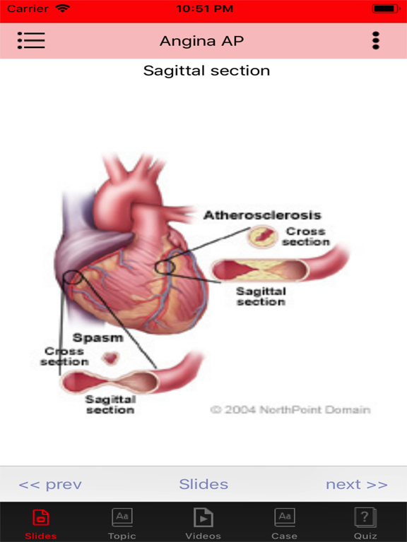 Angina offline iPad screenshot