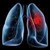 Lung Cancer:Research,Symptoms and Treatment