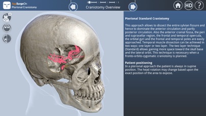 Pterional Craniotomyのおすすめ画像2