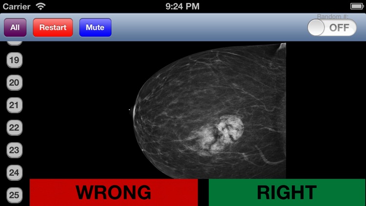 Mammography Flashcards