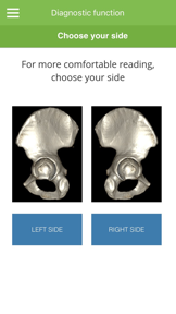 Acetabular Diagnosis Tool screenshot
