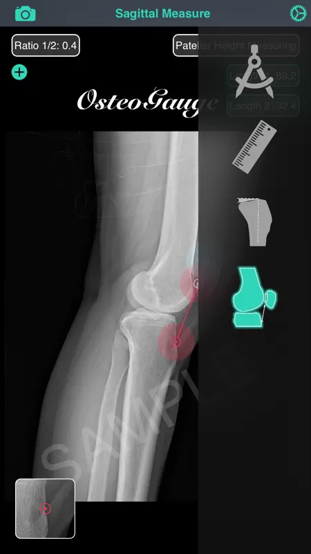 OsteoGauge - lower limb screenshot 1 of 5