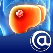 Hepatocellular Carcinoma