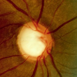 Glaucoma Calc