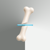 OsteotomyMR