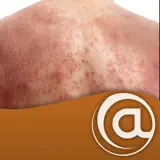 Atopic Dermatitis - Ícone do app