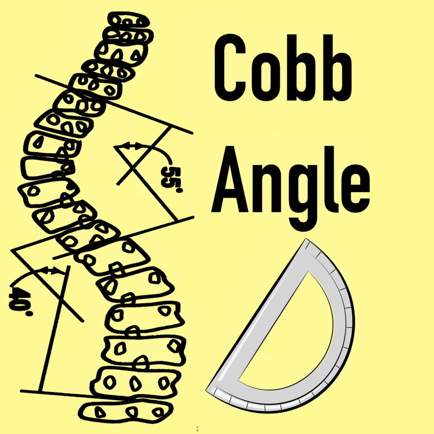 CobbAngleApp