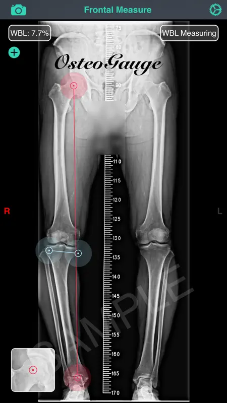 OsteoGauge - lower limb screenshot 4 of 5