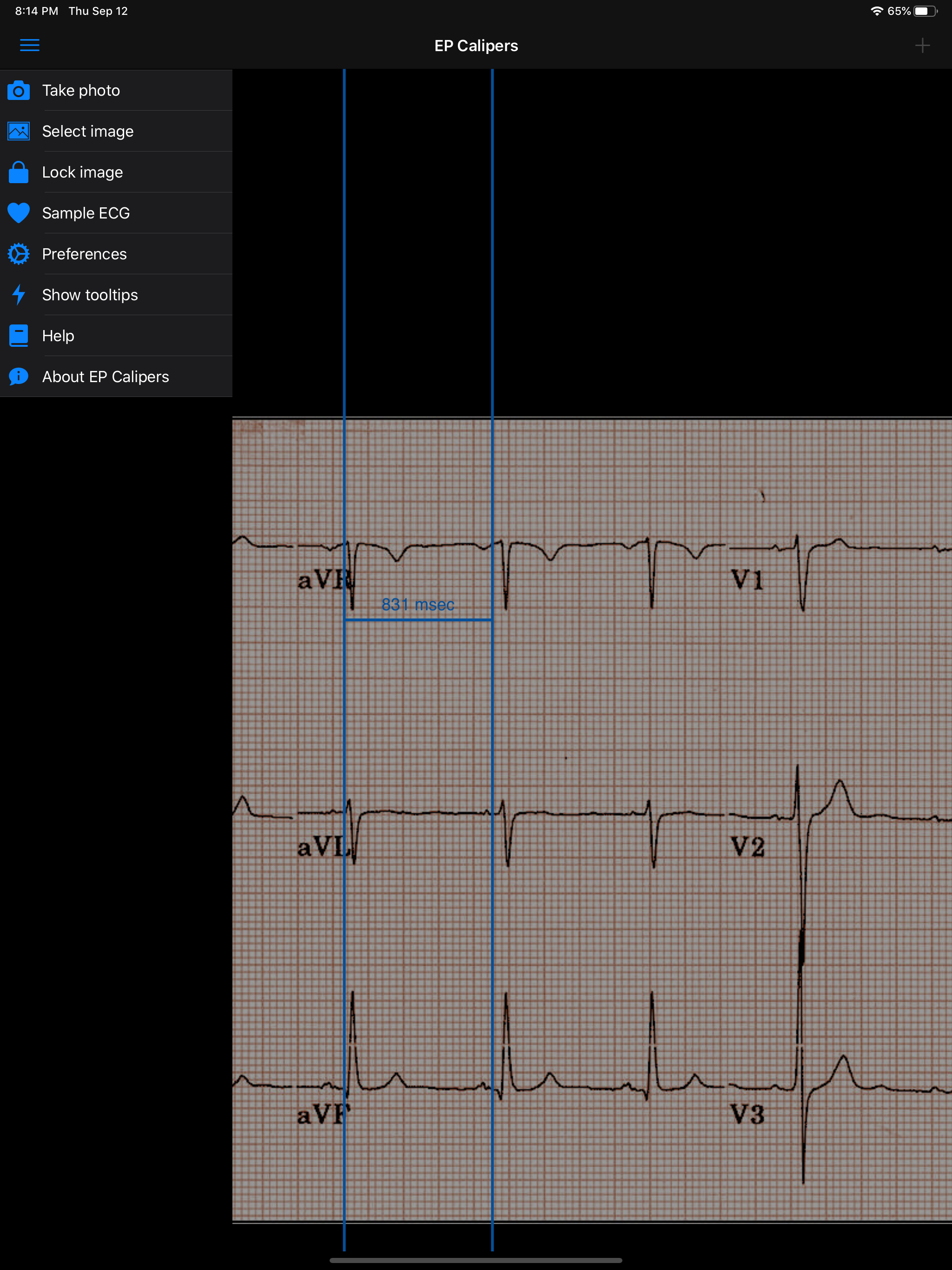 EP Calipers screenshot 17