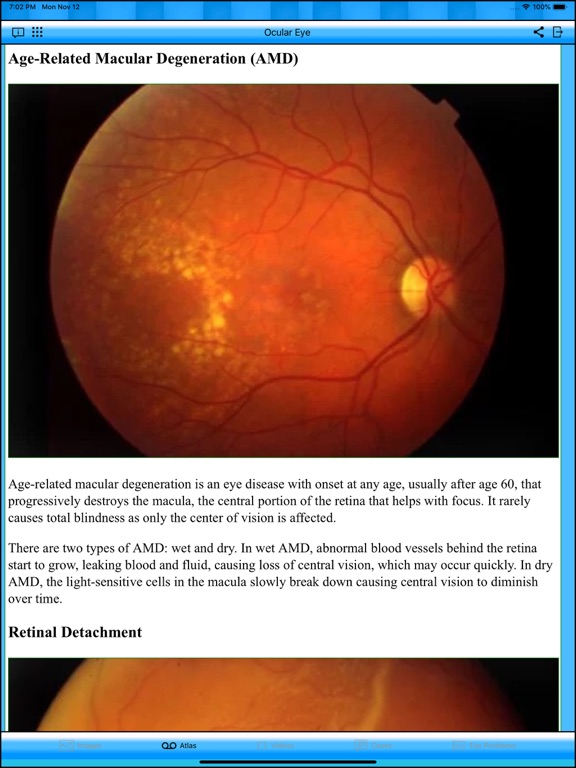 Ocular Eye iPad screenshot
