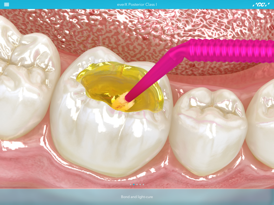 Screenshot #6 pour GC Restorative Dentistry