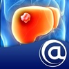 Hepatocellular Carcinoma icon