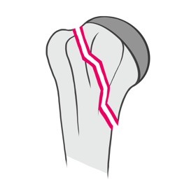 螢幕擷取畫面 (5) Classify - FractureCode
