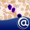 Chronic Lymphocytic Leukemia icon